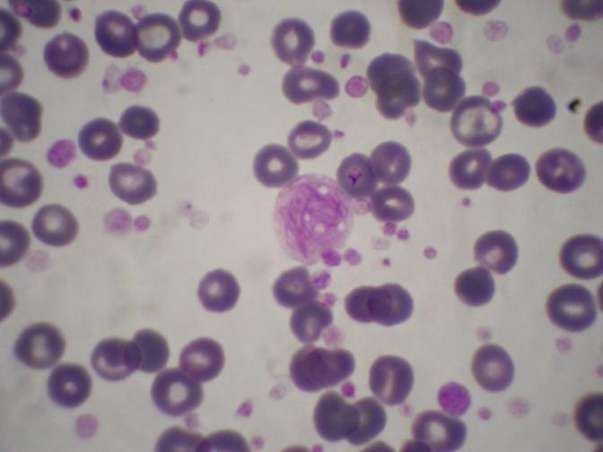 Trombocitemia Esencial NMPc caracterizada por una trombocitosis mantenida en sangre periférica ( 500.
