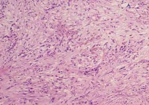 Mielofibrosis Primaria(MFP) Enfermedad clonal de la célula madre progenitora hematopoyética caracterizada por fibrosis progresiva de la MO y el desarrollo de hematopoyesis extramedular Caracterizada