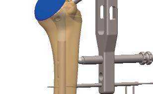 Bloqueo distal : Proceder de la misma manera que en el bloqueo proximal, dejando la aguja distal en su lugar.