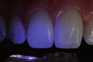 fotocurable y autoadhesiva para desoclusión dental