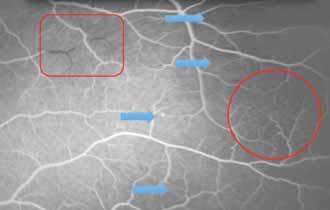 paralelismo de las capas retinianas externas en la macula temporal. (fig 8) Figura 5.