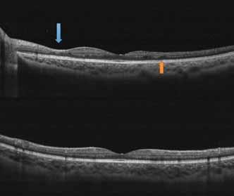 Fase arterio venosa de la AF del ojo izquierdo: oclusiones arteriales zonas de isquemia y cortocircuitos arteriovenosos en la región temporal superior sin evidencia de