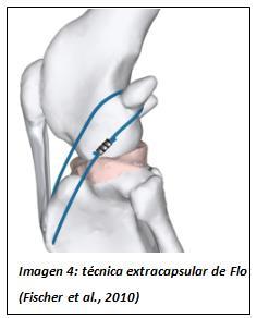 ligamento colateral lateral, forzándolo cranealmente y estabilizando en mayor medida la articulación. Estabilización extracapsular de Flo (Flo, 1975; Martínez et al., 1998; Fischer et al.