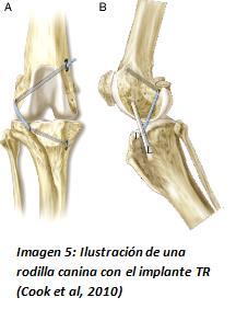 Para conseguir la estabilidad de la rodilla, se pasan dos suturas (lateral y medial) a través de ambos ligamentos femorofabelares y atraviesan un túnel, previamente practicado, en la tuberosidad