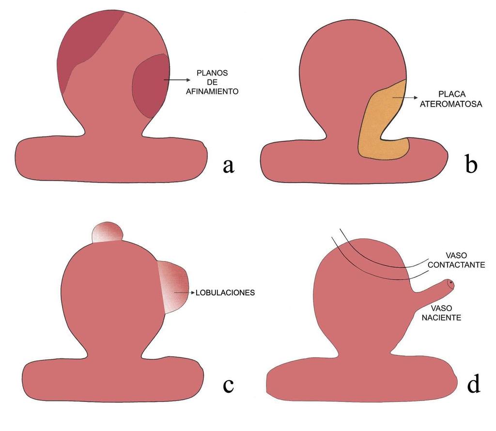 2c), y vasos arteriales relacionados con el saco y el cuello aneurismático (Fig. 2d). Fig. 2 a d.