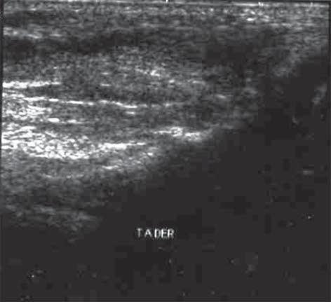 Evaluación ultrasonográfica del tendón de Aquiles en niños con pie equino varo aducto congénito del Hospital Shriners para Niños de México, AC.