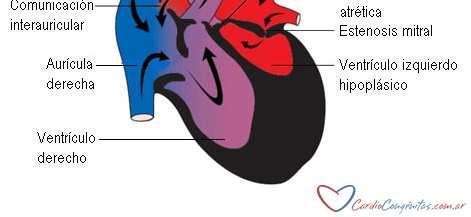 arteria pulmonar y ductus arterioso el VD plaza la AO descendente, ascendente, arco culación