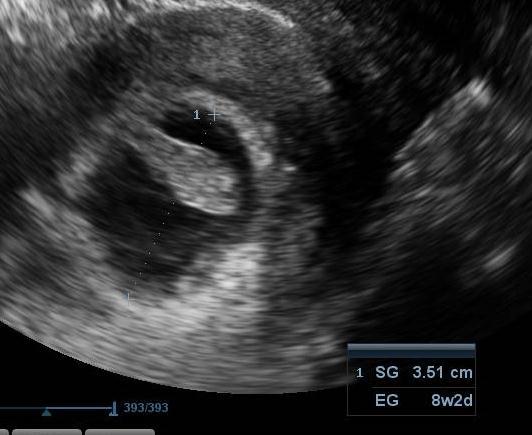 Saco gestacional de 35 mm de bordes regulares, en su interior se observa presencia de embrión con