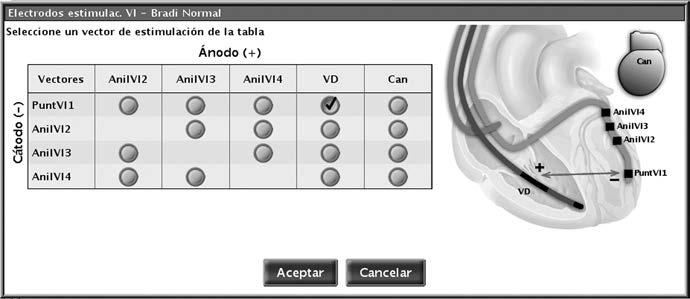 4-64 Terapias de estimulación Configuración del cable La ilustración de la parte derecha de la tabla se ajustará dinámicamente para reflejar la configuración VI seleccionada actualmente.