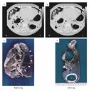 Complicaciones de la VM Barotrauma/Volotrauma Gasto Cardíaco PIC Función renal