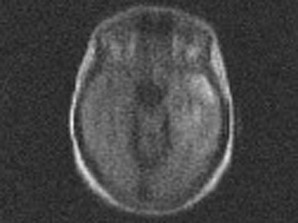 Fig. 10: secuencia FLAIR dónde vemos hiperintensidad en corteza del lóbulo temporal izquierdo, ínsula y circunvolución cingular. Fig.