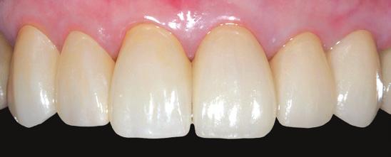 Fotografías de casos antes y después con Anterior CASO 1 Las coronas en el diente n.