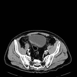 Ante la imagen hepática y con sospecha de metástasis a ese nivel; qué tumor en este paciente sería el primario más probable: vesical o renal? 2.