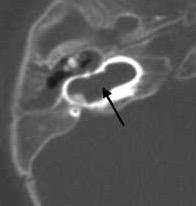 fistula de líquido cefalorraquídeo (Gusher) durante la intervención de la implantación coclear 39. Figura 12.