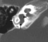 Imagen de Tac con anomalías de canal semicircular lateral y posterior 4.5.