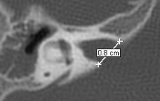 Birman y Gibson 46 publicaron que el CAI dilatado estaría asociado a una dehiscencia parcial del fondo lateral del mismo, aumentando la comunicación