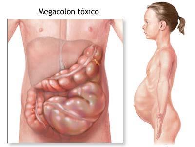 Megacolon tóxico Rápido ensanchamiento del colon, con dolor y distensión