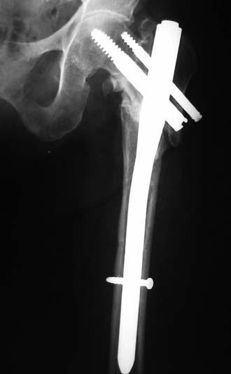 En la actualidad, el sistema más utilizado para las fracturas del fémur proximal es probablemente el clavo-placa deslizante.