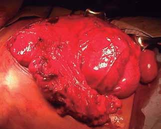 Tumor tritón del retroperitoneo Se tomó una biopsia del tumor retroperitoneal por trucut, con la que se diagnostica sarcoma pleomórfico indiferenciado de alto grado.