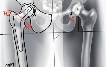 5 Marque la prótesis apropiada usando el calibrador en la misma posición de abducción-aducción que el fémur dibujado en