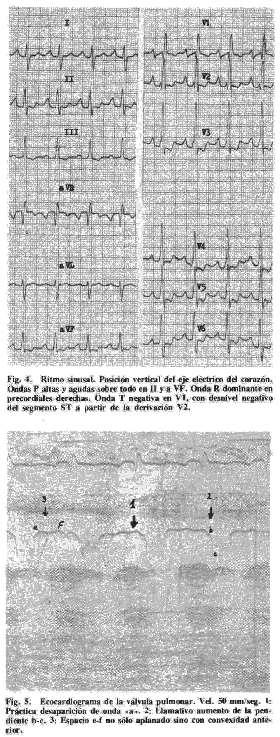ARCHIVOS DE BRONCONEUMOLOGIA. VOL. 17. NUM. 4. 1981 cuando la insuficiencia tricuspídea aumenta el flujo de llenado rápido ventricular.