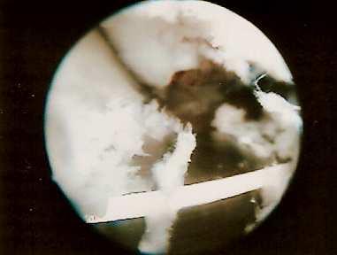 2. Introducción del artroscopio por el túnel peroneo y