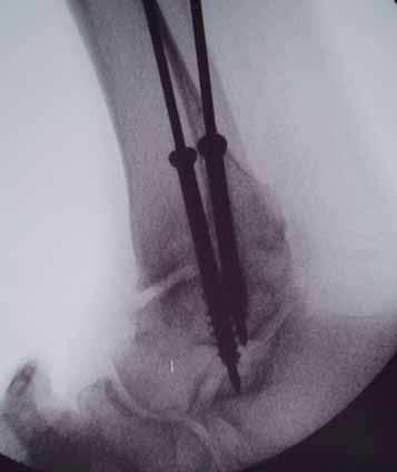 bearing is safe following arthroscopic ankle