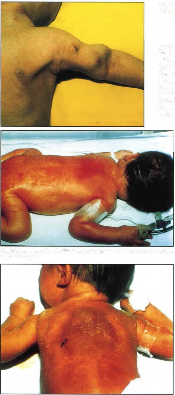 María Eisa Giovo y colaboradores Fig. 3: Caso clínico Nº 2. Nódulos en cara anterior de brazo izquierdo. Fig. 4: Caso clínico N 3.