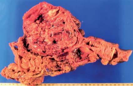 M. PÉREZ R. y col. Figura 7 y 8. GIST de localización más frecuente en intestino delgado.