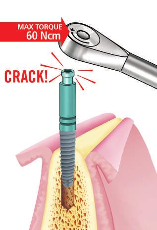 2.9 En caso de que se usa la carraca, las fuerzas ejercidas sobre el implante y por consecuencia sobre el hueso periimplantario pueden volverse excesivas.