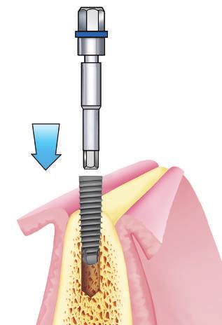 aplicación de un torque de 140 Ncm y permiten por eso la remoción del implante. 2.