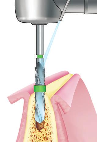 Implante L = 10 mm, ampliar el sitio implantar hasta la marca correspondiente a 8 mm). Volver a introducir el implante con el motor para implantología, repitiendo los pasos 2.3-2.