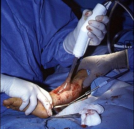 Fracturas Abiertas Tratamiento ABC Cuidados Politrauma Urgencia quirúrgica (6-8 horas)