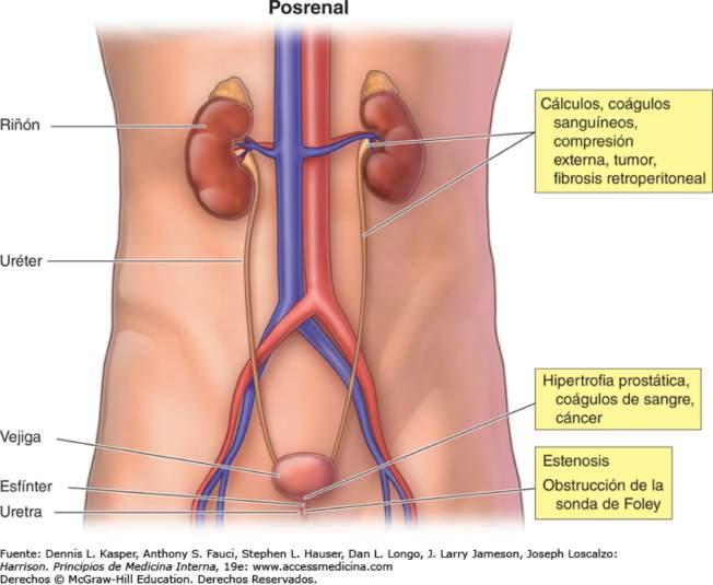 Insuficiencia renal aguda posrenal Aparece cuando hay bloqueo agudo, parcial o total de la corriente de orina que normalmente es