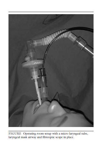 Sin EMG: Visualización de las cuerdas vocales durante la disección. Palpación del músc cricotiroideo después de la estimulación del nervio. Respuesta de presión glótica.
