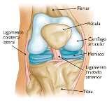 2.- INTRODUCCIÓN El contacto entre el inserto femoral metálico y el inserto tibial de polietileno en un reemplazo total de rodilla, resulta en una compleja distribución de esfuerzos tanto sobre la
