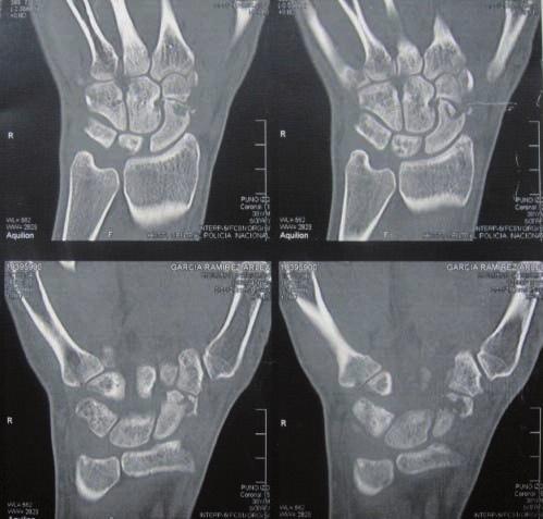 que las complicaciones más frecuentes de este tipo de fracturas sean la osteonecrosis y la no-unión del escafoides, que se presentan en el 10 al 15% de los casos, aproximadamente.