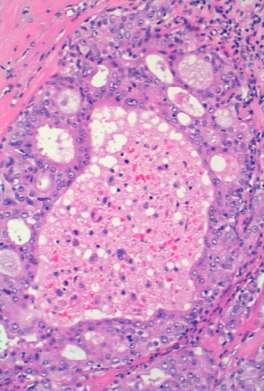CARCINOMA DUCTAL DE GLÁNDULA SALIVAL Adenocarcinoma alto grado Infiltrativo Similar carcinoma ductal de
