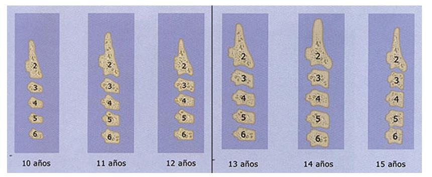 Figura 9: Proceso de maduración de las vértebras cervicales por edad.