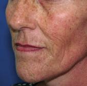 segura y efectiva, mejorando de forma global el aspecto de la piel.