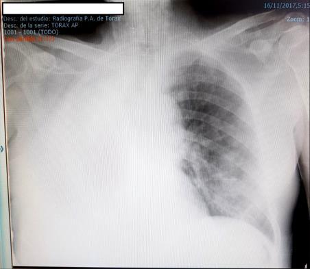 En las pruebas de imagen (TAC) se identificó una masa pulmonar derecha de 8