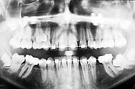 ENCLAVAMIENTO O IMPACTACIÓN Situación del diente retenido que ha perforado el techo óseo, con