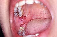CLÍNICA Lesiones localizadas ulceración retromolar faringitis unilateral de