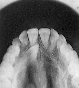 CLÍNICA DIAGNÓSTICO ausencia de diente en la arcada accidentes mecánicos, nerviosos,