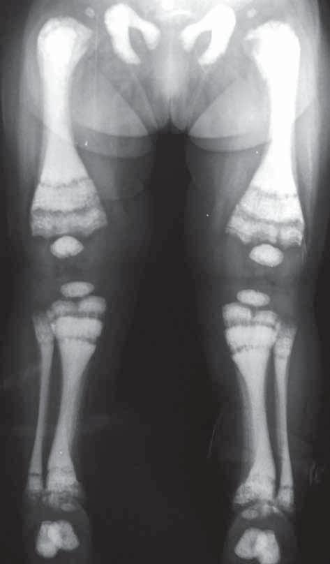 Tumoraciones óseas Las características generales de las tumoración asociadas a Displasias esqueléticas son el lento crecimiento y generalmente la presencia de antecedentes familiares.