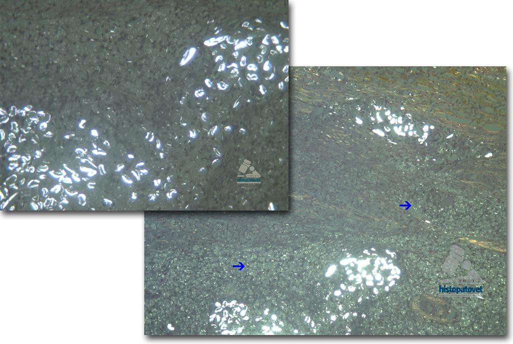 Fig. 5 A- B. Dos fotos con luz polarizada para ver el material. Las flechas muestran como los macrófagos están llenos del material(fagocitosis).