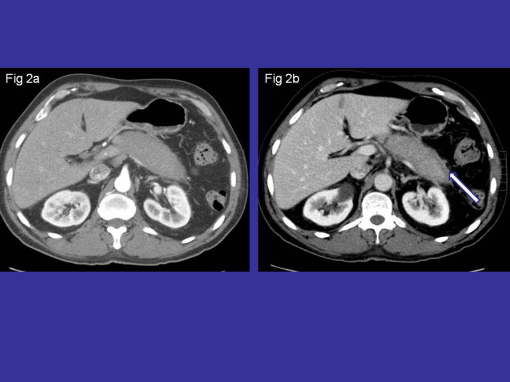 Fig. 2: Paciente de la figura 1. TC con contraste (Fig.