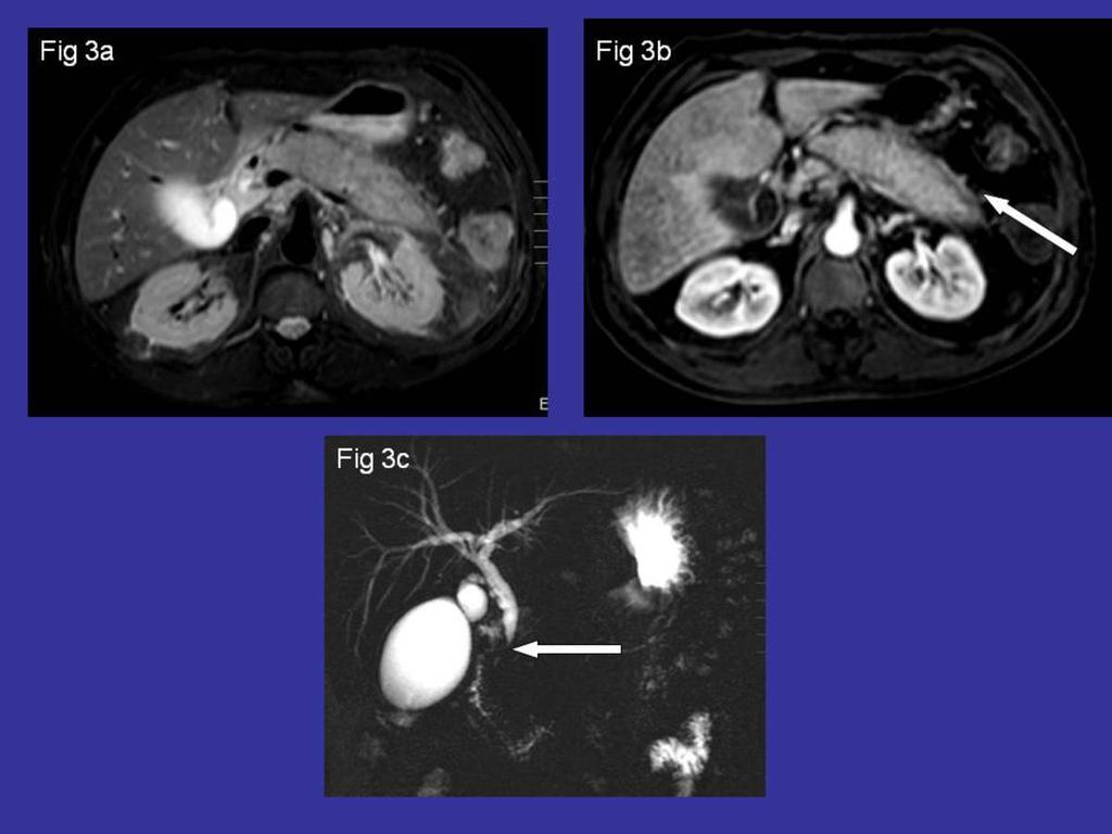 Fig. 3: Paciente de la figura 1 y 2. Imagen de RM potenciada en T2 con supresión grasa (Fig. 3a) que muestra un aumento difuso del páncreas. Tras administración de contraste (Fig.