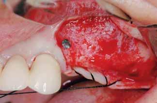 Incisión que preserva la papila del diente mesial.