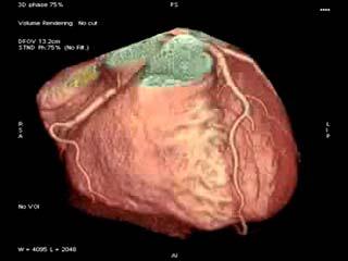 Evaluación diagnóstica TC coronario En pacientes con IC, el estudio no invasivo de la